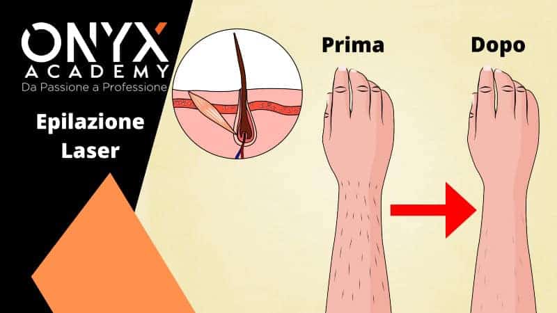 epilazione-laser-prima-e-dopo