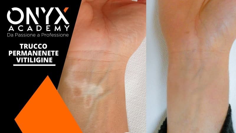 vitiligine-permanente-trucco